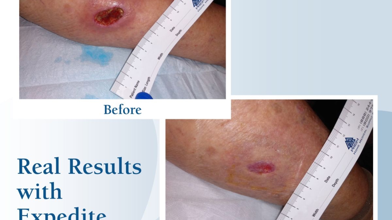 Wound-Results-Photo